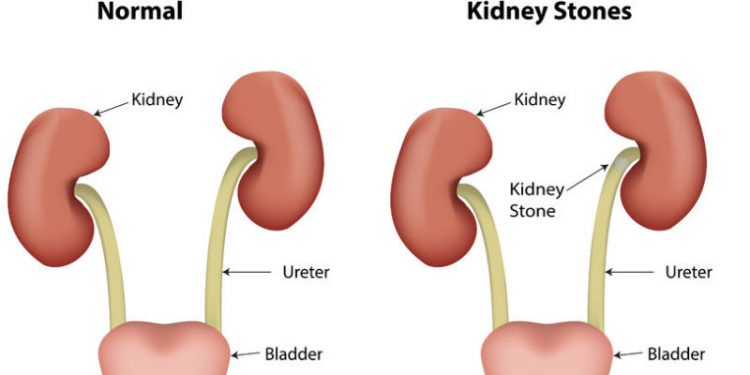 31812763 - kidney stones