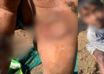 അഞ്ച് വയസ്സുകാരനോട് കൊടും ക്രൂരത; കുസൃതി കാട്ടിയതിന് അമ്മ പൊള്ളലേൽപ്പിച്ചു; ഇടുപ്പും കാലും പൊള്ളിയടർന്നു