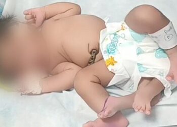 മധ്യപ്രദേശില്‍ നവജാത ശിശുവിന് നാലുകാലുകള്‍