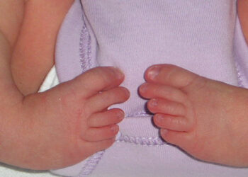 വക്രപാദ വൈകല്യം നേരിടാൻ ശസ്ത്രക്രിയേതര പ്രവർത്തനങ്ങൾ; കൂടുതൽ സംസ്ഥാനങ്ങളിലേക്ക് വ്യാപിപ്പിക്കാൻ  ക്യൂർ ഇൻറർനാഷണൽ ഇന്ത്യാ ട്രസ്റ്റ്