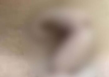 ആറ് സെന്റീമീറ്റർ വാലുമായി പെൺകുഞ്ഞ് പിറന്നു; അപൂർവ്വ സംഭവം