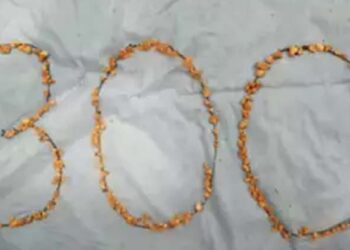 ശസ്ത്രക്രിയയിലൂടെ നീക്കിയത് 300 കിഡ്നി സ്റ്റോണുകൾ; ഞെട്ടൽ മാറാതെ ഡോക്ടർമാർ