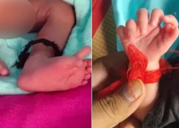 അപൂർവ്വങ്ങളിൽ അപൂർവ്വം; 26 വിരലുകളുമായി കുഞ്ഞ് ജനിച്ചു; ഞെട്ടലോടെ ശാസ്ത്ര ലോകം