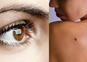 മറുകുകൾ പറയും ചില രഹസ്യങ്ങൾ; മുഖത്തോ കൈവെള്ളയിലോ മറുകുണ്ടോ?: എന്നാൽ നിങ്ങൾ ഇത് ഉറപ്പായും അറിഞ്ഞിരിക്കണം