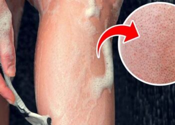 സ്‌ട്രോബറി ലെഗ്‌സ്; നിസാരമാക്കരുത് ഈ ചുവന്ന കുത്തുകളെ