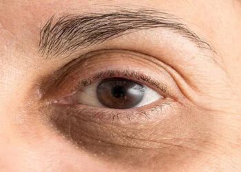 കണ്ണിന് താഴെയുള്ള കറുപ്പ് സൗന്ദര്യപ്രശ്നമല്ല, ശരീരം നൽകുന്ന മുന്നറിയിപ്പാണ്; അവഗണിക്കരുതേ