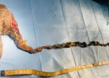 9 വയസുകാരിയുടെ വയറ്റിൽ 127 സെന്റിമീറ്റർ നീളത്തിൽ ‘ഹെയർബോൾ’; ശസ്ത്രക്രിയയിലൂടെ പുറത്തെടുത്ത് ആലപ്പുഴ മെഡിക്കൽ കോളേജ്