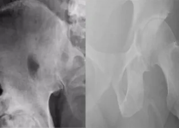 ജനനേന്ദ്രീയം അസ്ഥിയായി മാറുന്നു; കാൽമുട്ടിന് ചികിത്സ തേടിയെത്തിയ 63 കാരന്റെ എക്‌സ് റേ കണ്ട് ഞെട്ടി ഡോക്ടർമാർ; അപൂർവ്വ രോഗം