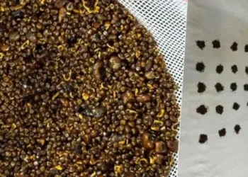 കടുത്ത വയറുവേദന; 70 കാരന്റെ വയറ്റിൽ നിന്ന് 6,000 ത്തോളം കല്ലുകൾ നീക്കം ചെയ്തു