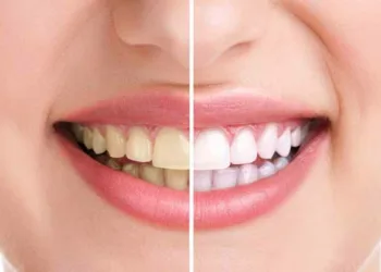 മുല്ലമൊട്ട് പോലെ തിളങ്ങുന്ന പല്ല് വേണോ, പരിഹാരം വീട്ടില്‍ തന്നെ, ചെയ്യേണ്ടത് ഇത്രമാത്രം