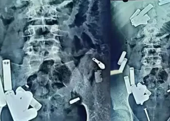 ശ്വാസ തടസ്സത്തെ തുടർന്ന് ചികിത്സ തേടി; 14 കാരന്റെ വയറ്റിൽ ബാറ്ററിയും ബ്ലേഡും ഉൾപ്പെടെ  65 വസ്തുക്കൾ