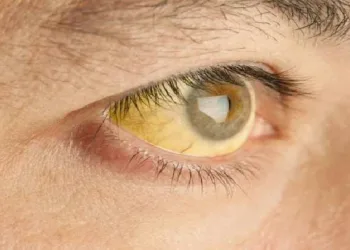 55 ദിവസത്തിനിടെ  4500 രോഗികൾ; ചൂടു കൂടിയതോടെ  സംസ്ഥാനത്ത് മഞ്ഞപ്പിത്ത ബാധിതരുടെ എണ്ണം പെരുകുന്നു