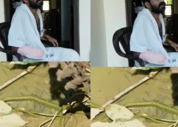കുളം വൃത്തിയാക്കുന്നതിനിടെ മീൻ കൈയിൽ കൊത്തി ; അണുബാധയെ തുടർന്ന് യുവാവിന്റെ കൈപ്പത്തി മുറിച്ചുമാറ്റി