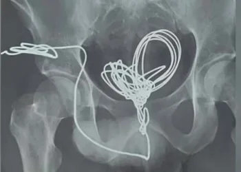 അസഹനീയ വേദന; യുവാവിന്റെ മൂത്രനാളിയിൽ കണ്ടെത്തിയത് 3 മീറ്ററോളം നീളമുള്ള ഇലക്ട്രിക് വയർ