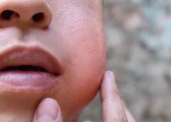 സംസ്ഥാനത്ത് മുണ്ടിനീര് വ്യാപകമാകുന്നു; ഈ മാസം മാത്രം 475 കേസുകൾ