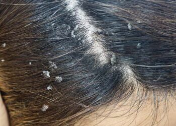 താരനാണോ പ്രശ്നം…പരിഹാരം വീട്ടിലുണ്ടേ